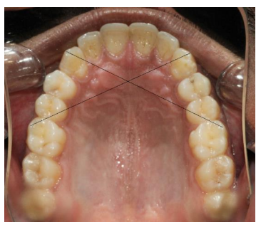 A novel approach for establishing angular ratio at the diagonal junction between the maxillary canine and maxillary first molar- A prospective photogrammetric study