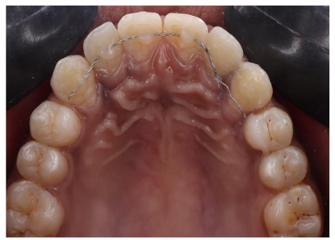 Technique to stabilize a lingual retainer under rubber dam isolation: A case series and review