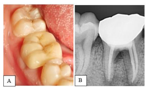 From complication to conservation: MTA- Assisted furcal perforation repair in a mandibular molar